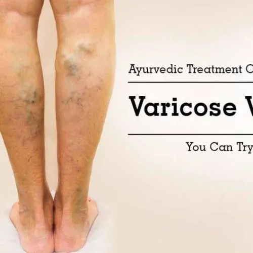 67478498_1833320080104320_6627355513795379200_n Varicose Veins