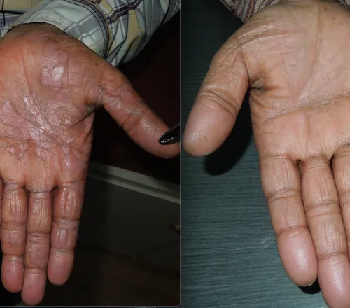 62529694_1738414729594856_1717219570952962048_o Psoriasis