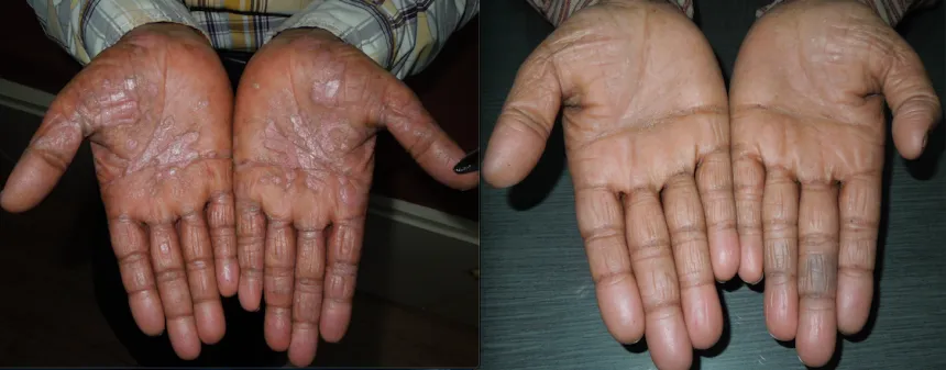 Psoriasis